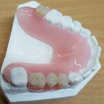 Acrylic Partial Dentures