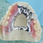 Chrome Cobalt Dentures