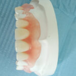 Flexi Denture and ComFlexin Dentures